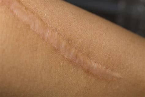 Differentiating and Treating Hypertrophic Scars and Keloids ...
