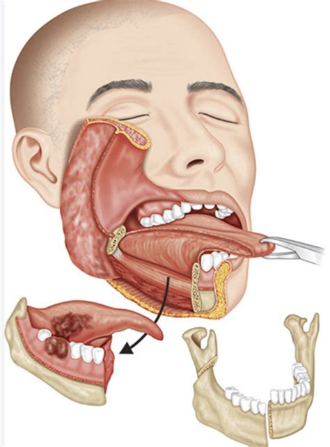 Jaw Cancer Surgery - Renda Clinic