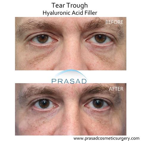 Under Eye Filler Before and After Photos - Prasad Cosmetic Surgery NY