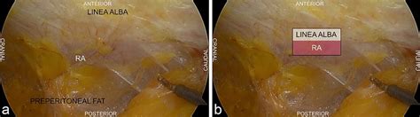 intraoperative picture showing  left contralateral rectus