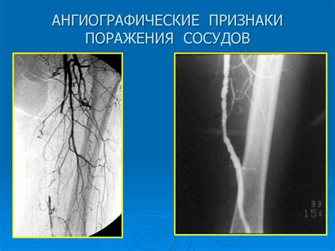 Облитерирующий эндартериит - презентация онлайн