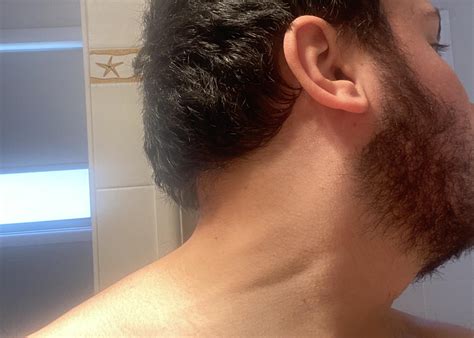 chronic tmj neck tension rtmj