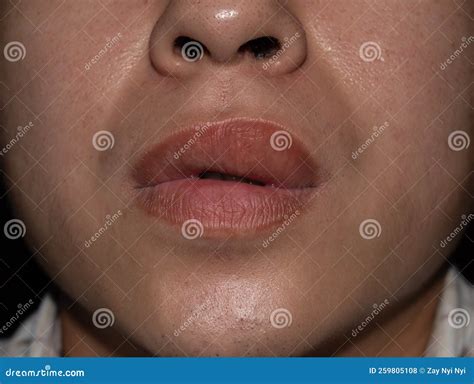 Lip Infection Swollen at Ronald Roe blog