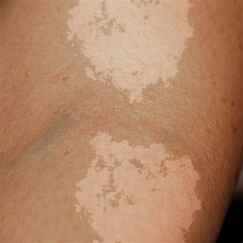 discoloration  loose skin