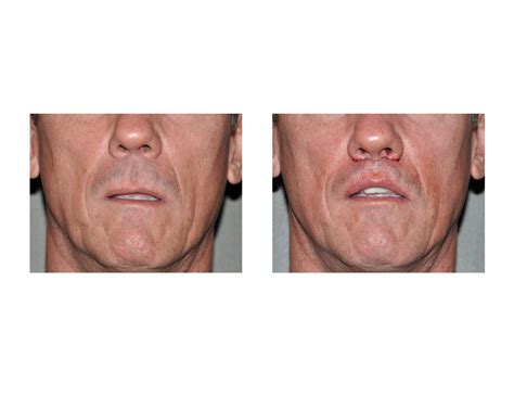 subnasal-lip-lift-in-men-dr-barry-eppley-indianapolis - Explore Plastic