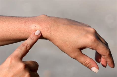 Bee sting allergy: Symptoms, causes, and treatment