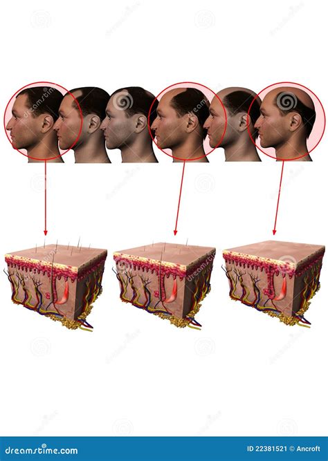 Balding Cartoons, Illustrations & Vector Stock Images - 1419 Pictures