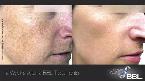 laser treatment  brown spots dermatology care  charlotte