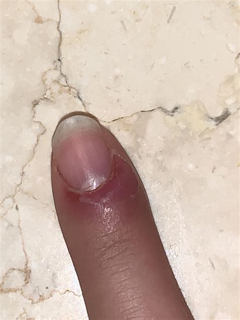 Started with an infected hangnail, any at home treatment advice? Or