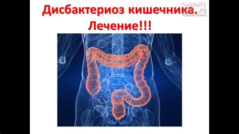 Дисбактериоз кишечника. Лечение. Алексей Яровой. - YouTube