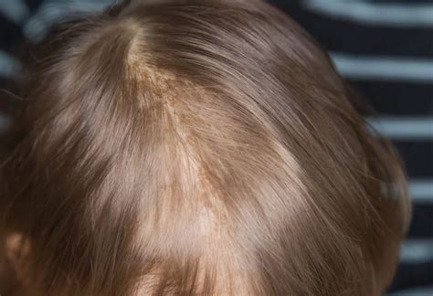 cradle cap  symptoms  treatments