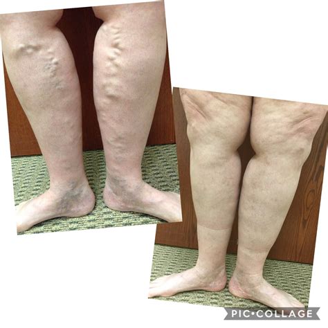RADIOFREQUENCY ABLATION - Vein Specialists of the Carolinas