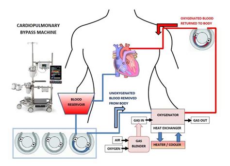 cardiopulmonary bypass machine cpb