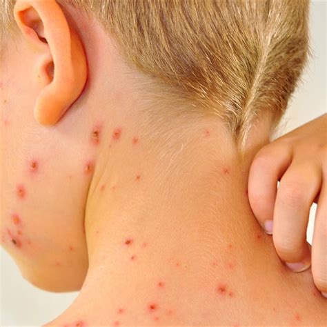 Chickenpox In Children