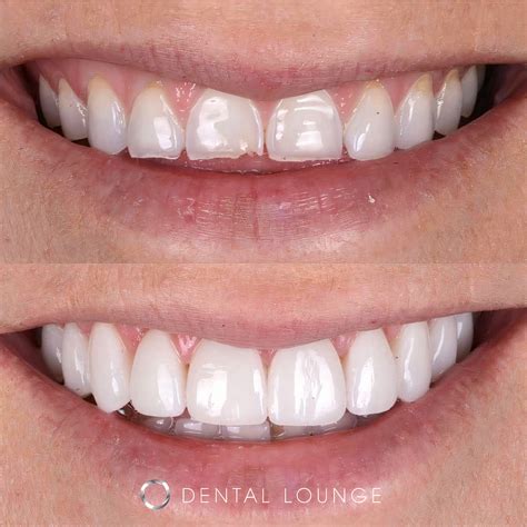 Dental Lounge - Rebuilding a worn down dentition by...