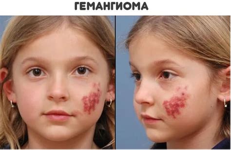 Гемангиома: что это, фото и симптомы, причины, лечение и виды ...
