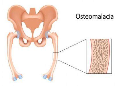 Osteomalacia - Standard Treatment Guidelines - Medical Dialogues