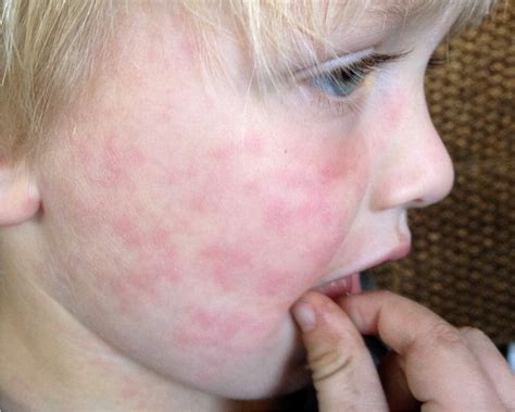 Viral Rash In Children Face - vrogue.co