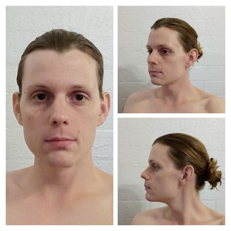 Will I ever pass without surgery? (11mo 21d HRT) : r/transtimelines