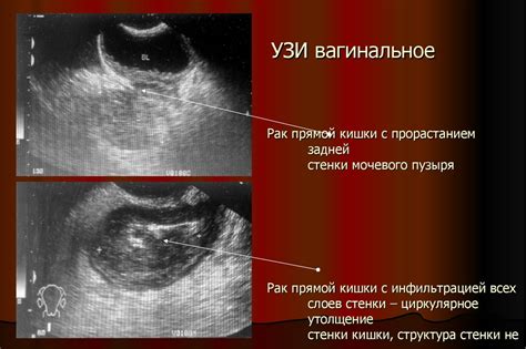 Колоректальный рак - презентация онлайн