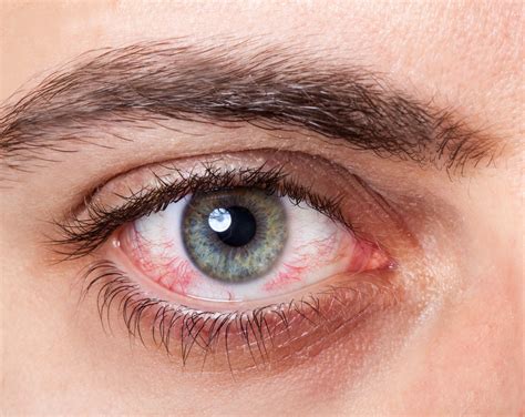 Eye Pruritus