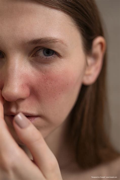 #rosacea – Integricare Dermatology