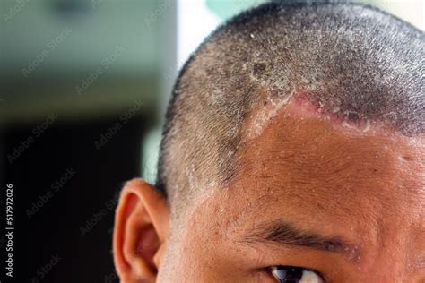 skin disease at the head, Dandruff is a common condition that causes ...