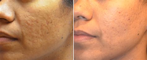 RF Microneedling for Acne Scars Results on African American Female