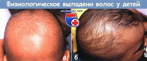 Травматическая потеря волос (алопеция) у детей