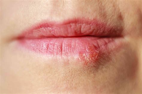Painstaking Lessons Of Info About How To Get Rid Of Herpes On The Lips ...