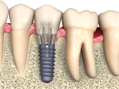 Targeted individuals implants