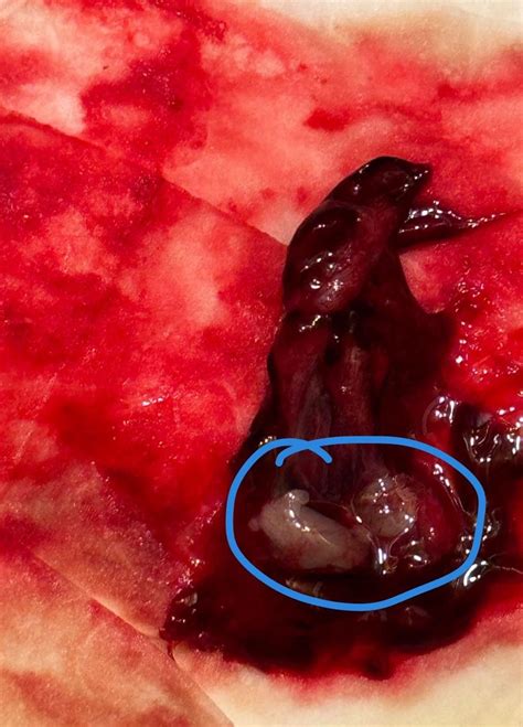 how to know if you had early miscarriage