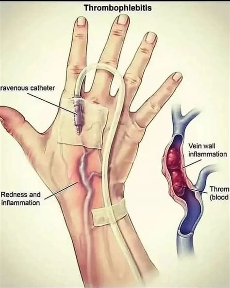 Inflammation Of A Vein