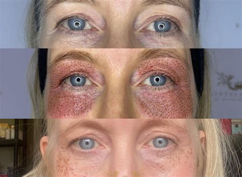 plasma  treatment face  eye aesthetics