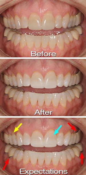 Teeth Bleaching Before And After