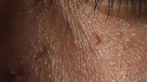 Wart on face. Macro shot of wart near eye. Papilloma on skin. 4897403