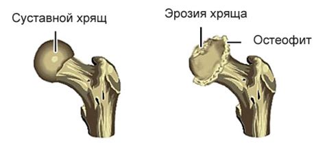Артроз тазобедренного сустава: симптомы и лечение, причины болезни