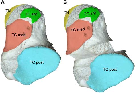 Hindfoot Issues in the Treatment of the Cavovarus Foot - Foot and Ankle
