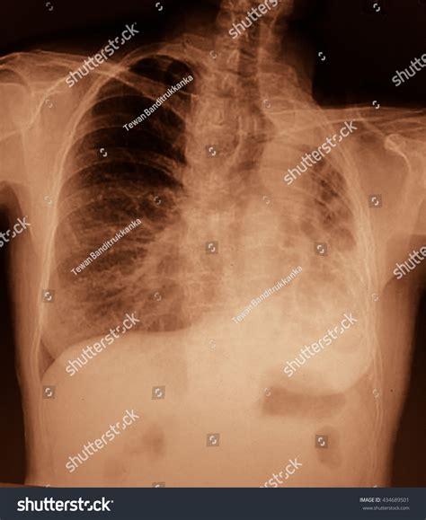 Lung Cancer Pleural Effusion Stock Photo 434689501 | Shutterstock