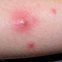 Symptoms of Staph and MRSA. 6 Common Signs of Staph Skin Infection