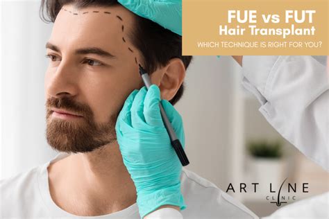 fue  fut hair transplant  technique     art