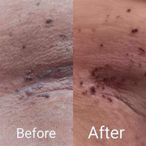 Timmy Skin Care Clinic - ️WARTS Common warts are small, grainy skin