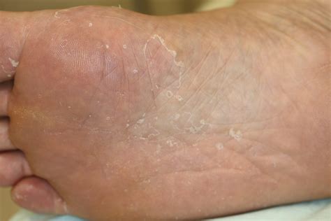 水虫、冬も油断禁物～かゆみ治まっても治療・対策を～｜トピックス｜時事メディカル｜時事通信の医療ニュースサイト
