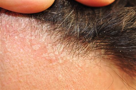 understanding seborrheic dermatitis