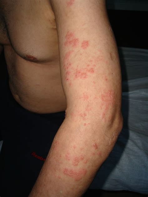 Herpes zoster - DocCheck