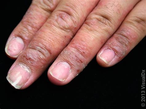 treating eczema  hands  fingers  pictures goodrx