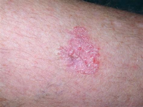 Symptoms Of Skin Cancer On Leg