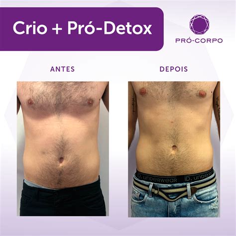 Monte De Vênus Antes E Depois - Criolipólise Monte De Venus Antes E Depois - Insights e Informações