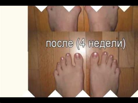 Вальгус Стоп - YouTube