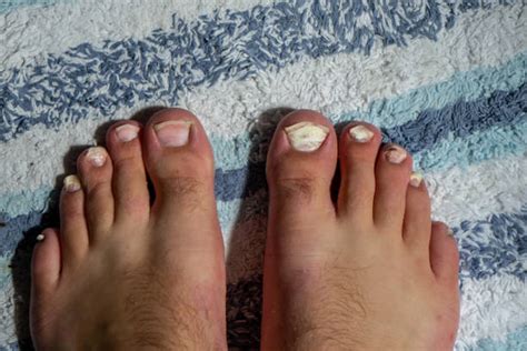 320+ Curved Toenails Stock Photos, Pictures & Royalty-Free Images - iStock